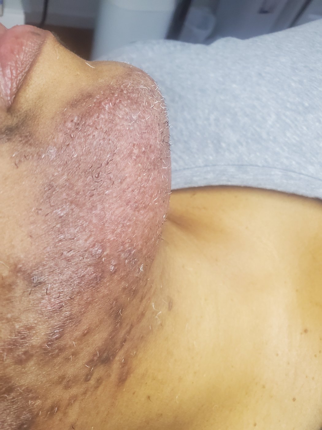 The same jaw and neck after one year: even skin tone, dark marks cleared, only fine white hairs remaining