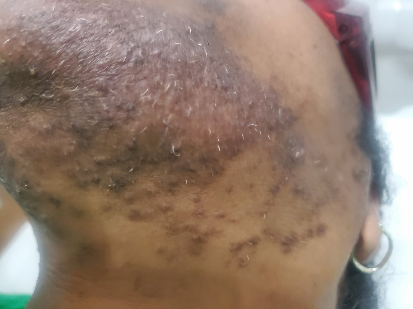 Jaw and neck before treatment: dense coarse dark hair with widespread dark marks around the follicles on Black skin