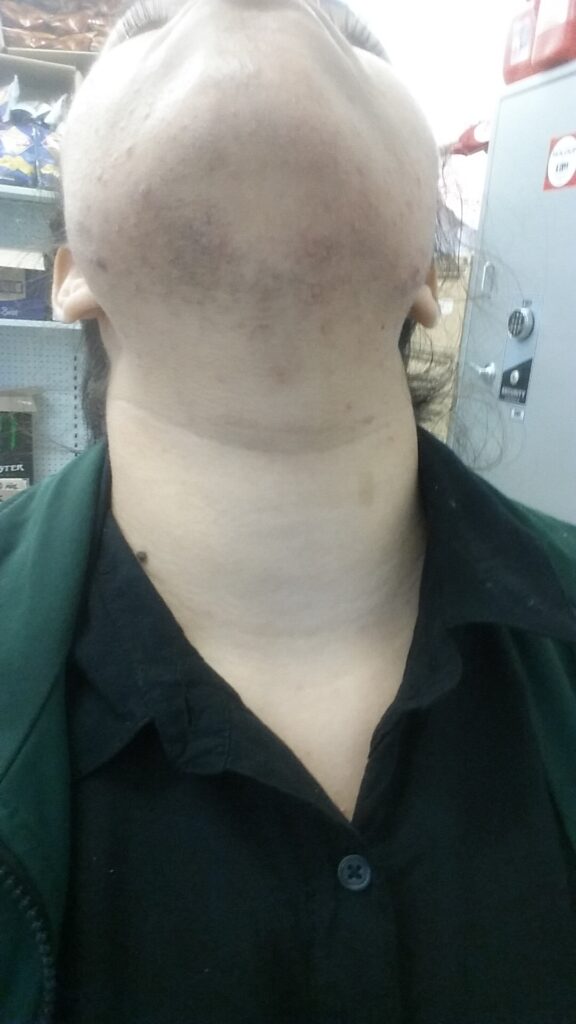 Dark shadow and shaving marks on a woman's chin and neck from shaving facial hair every day