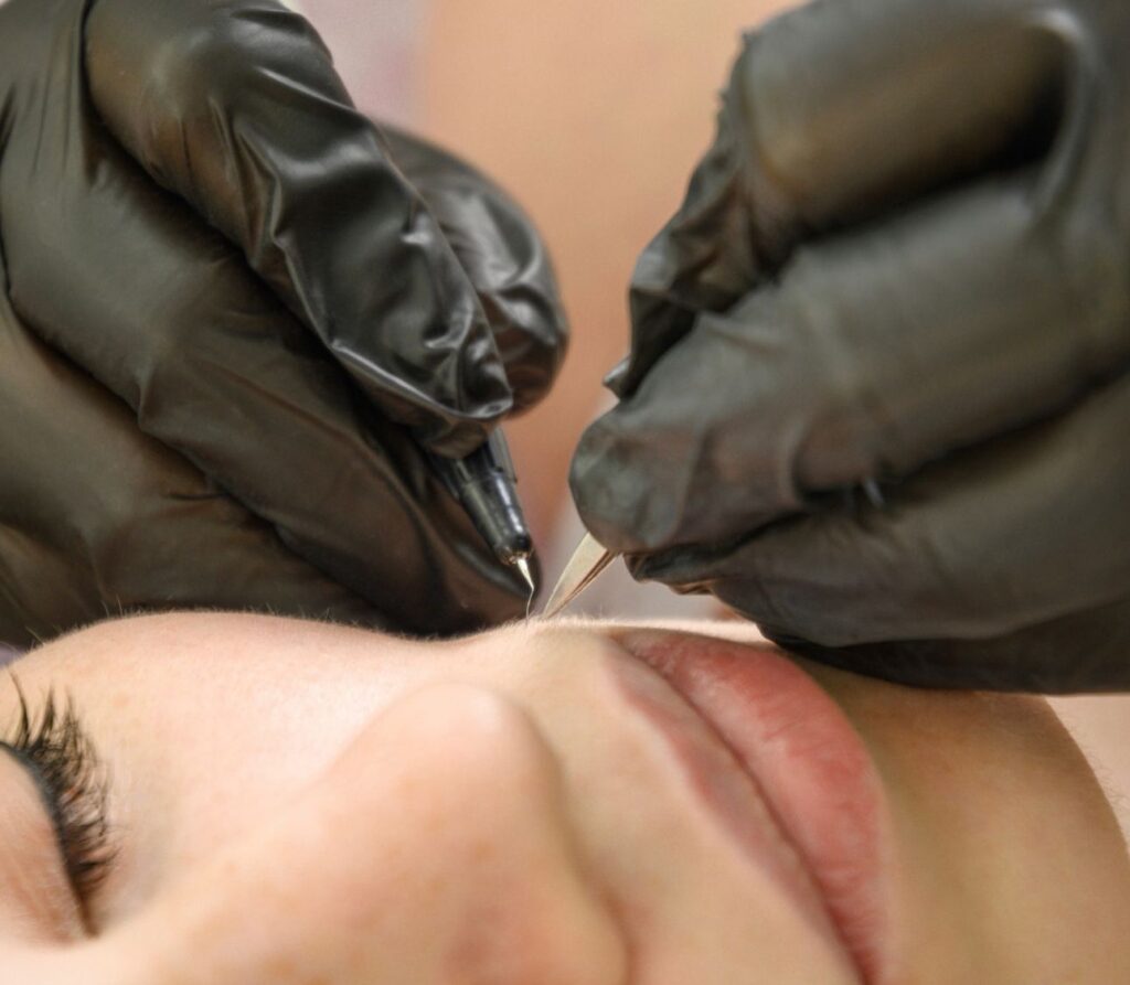 Electrolysis removing a single hair from the upper lip, one follicle at a time