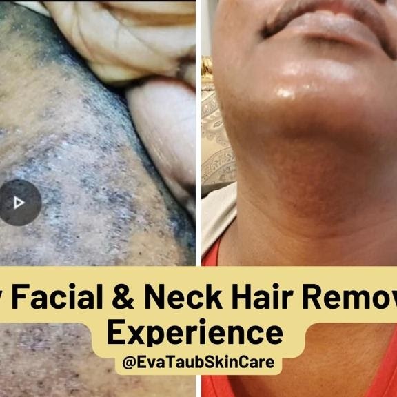 Chin and neck discoloration before and after treatment on Black skin