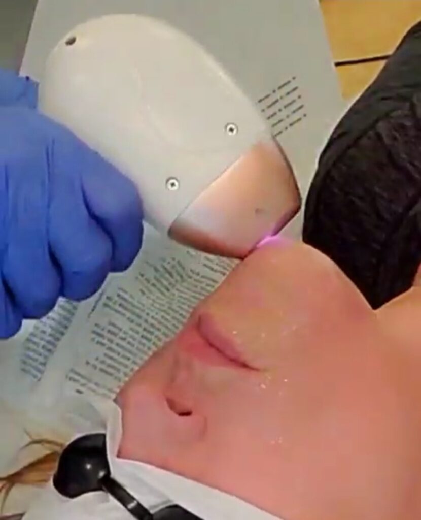 Laser hair removal on the upper lip at the Bay Harbor Islands studio