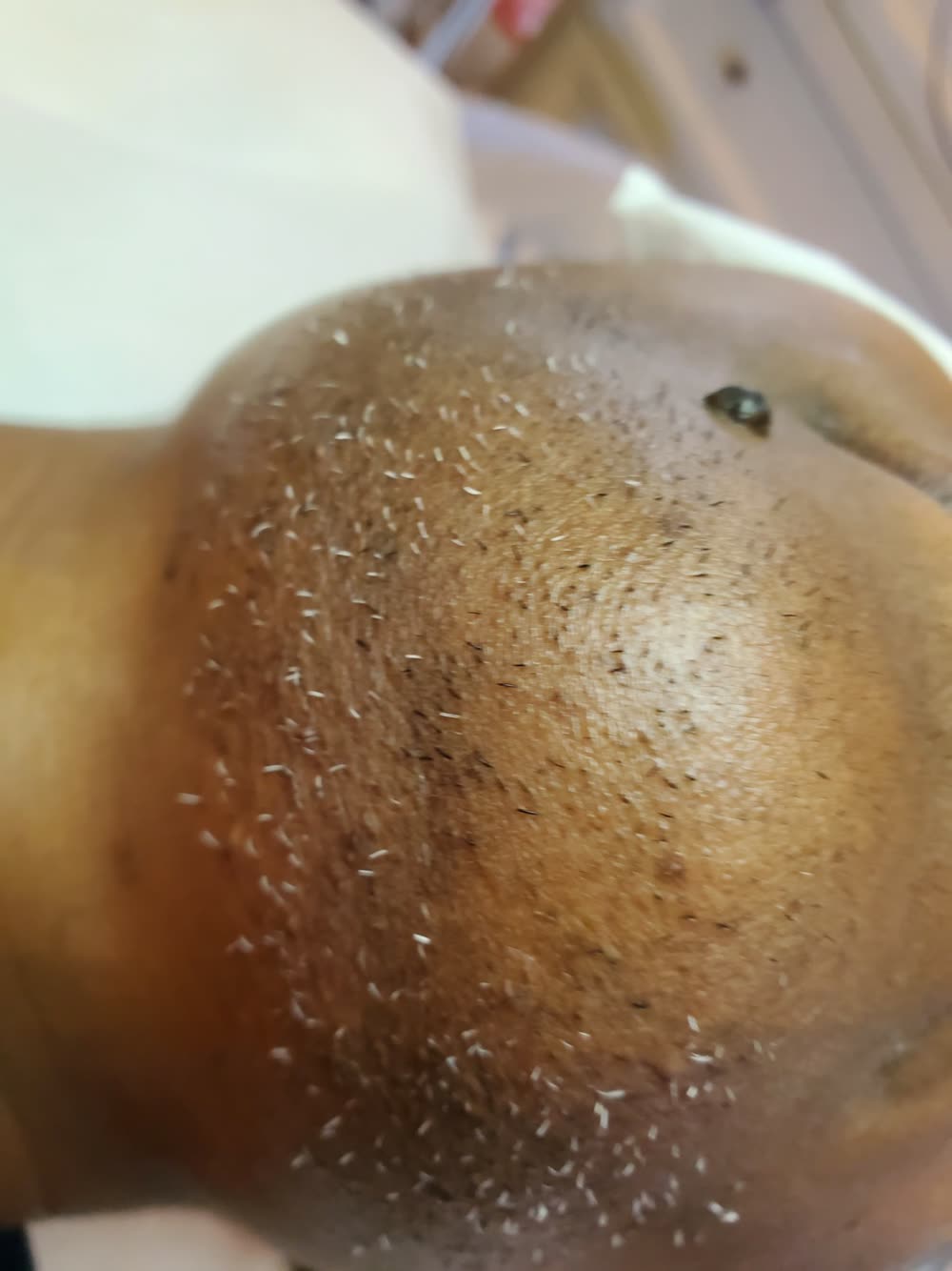 White and gray chin hairs on dark skin that laser cannot remove