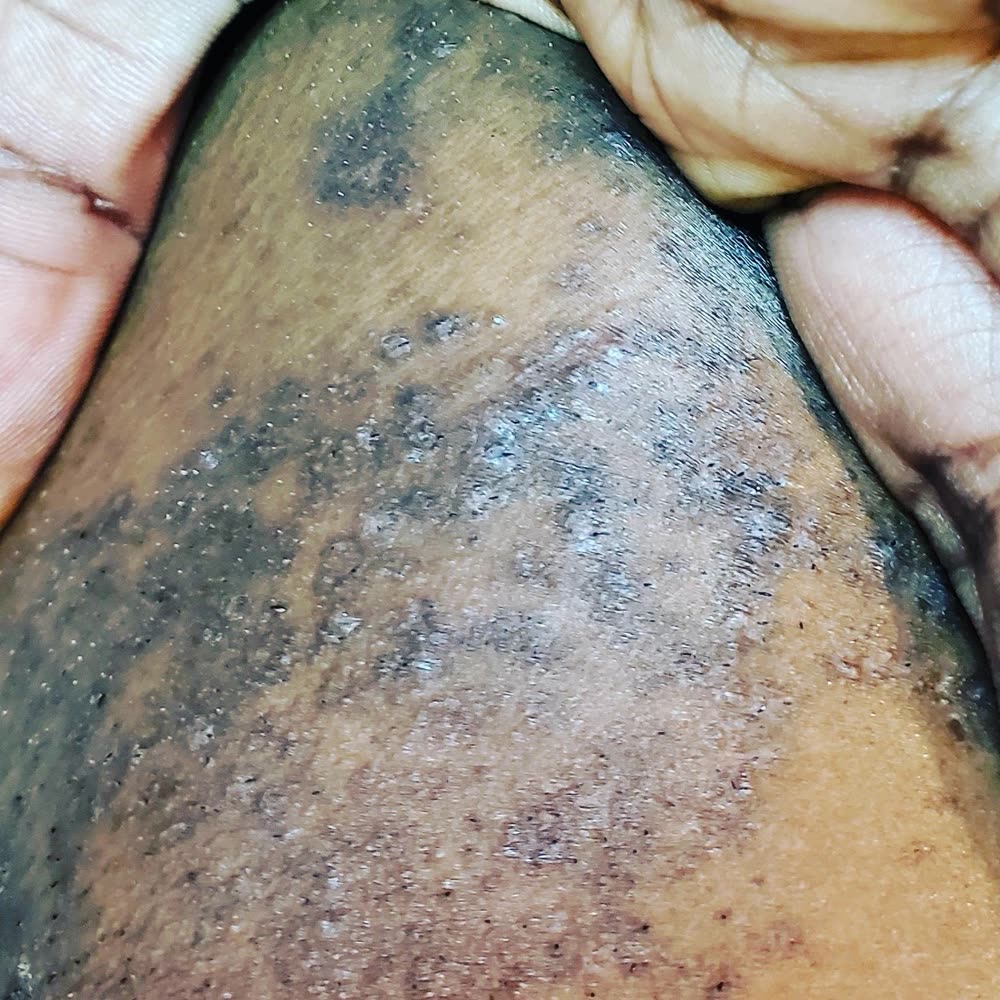 Dark patches on the chin from plucking and shaving on dark skin