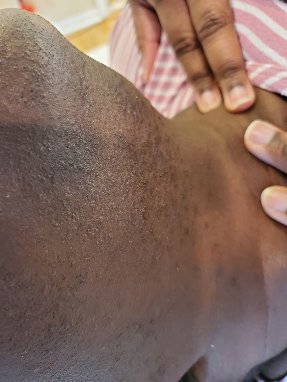 Dark chin and neck with stubble and dark marks on a Black woman