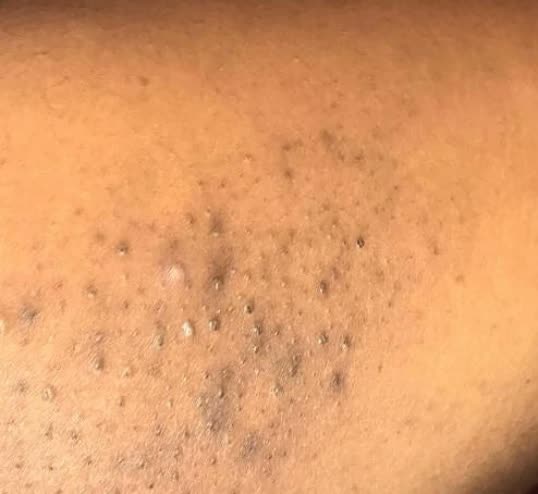 Bumps and dark marks from ingrown hairs on dark skin