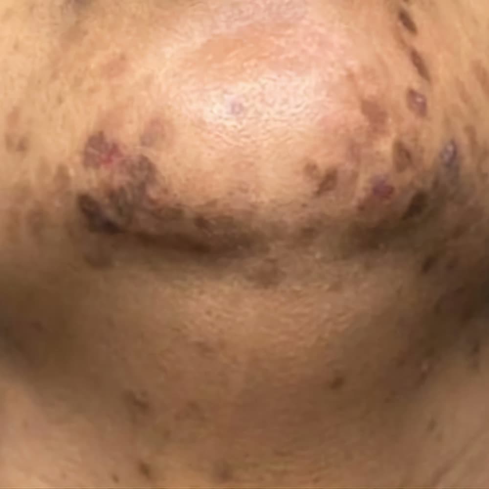 Dark spots from ingrown hairs on the chin of a woman with dark skin