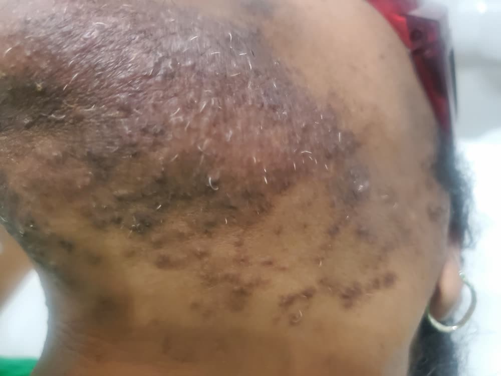 Dark irritated skin and ingrown hairs on the chin of a Black woman